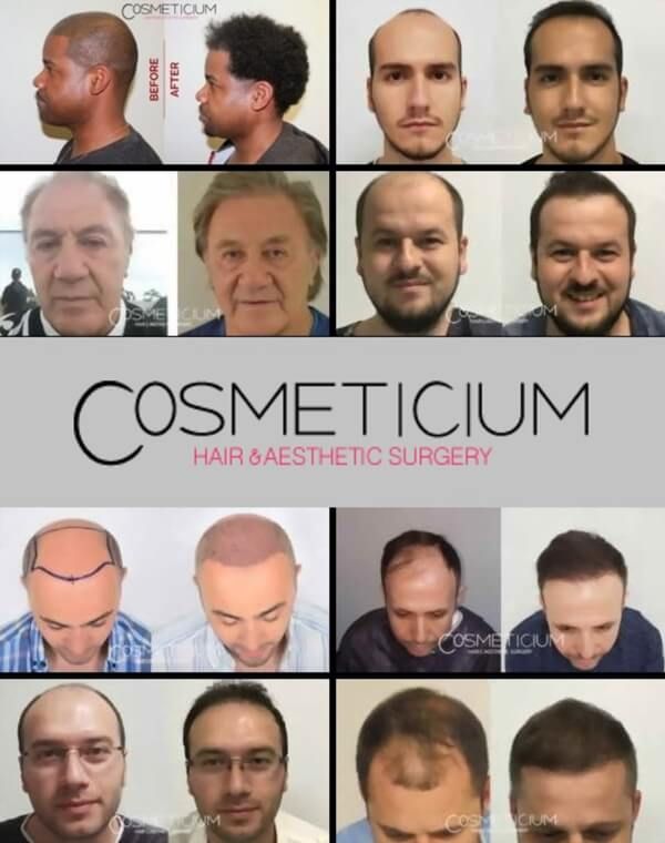 before and after hair transplant photos cosmeticium
