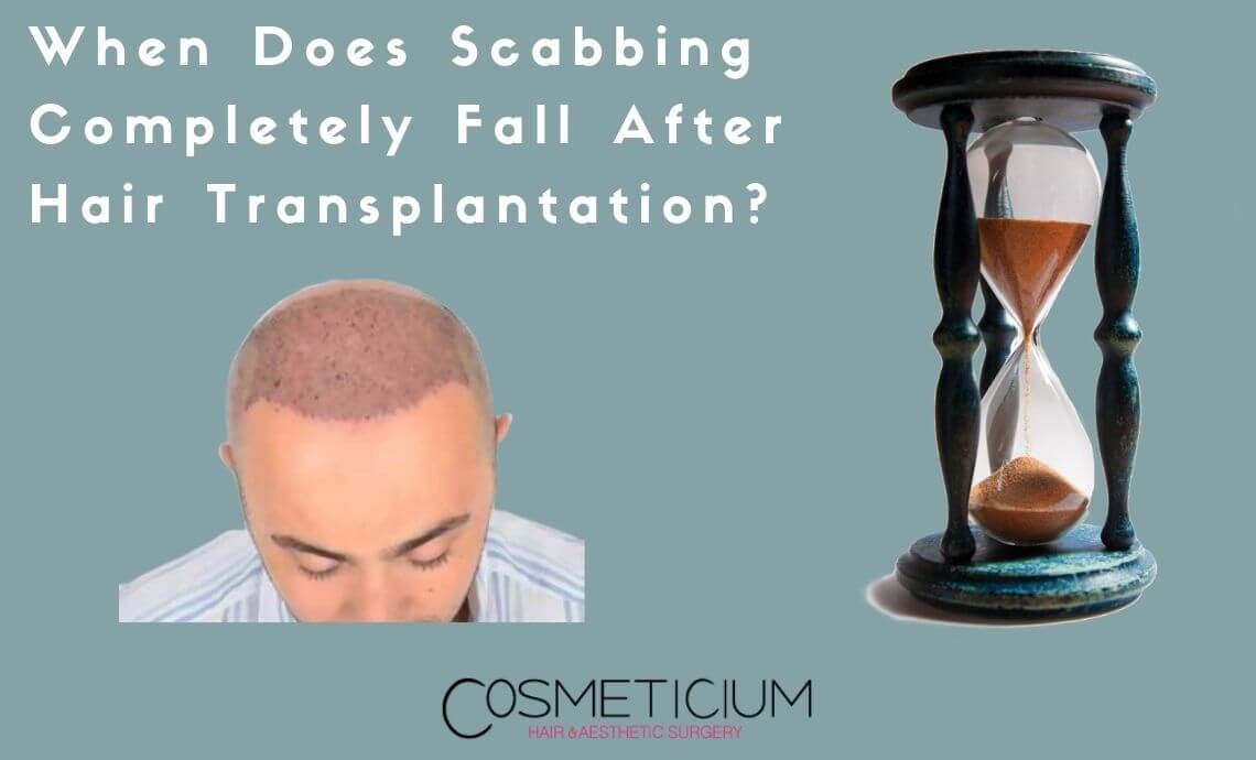 When Does Scabbing Completely Fall After Hair Transplantation?