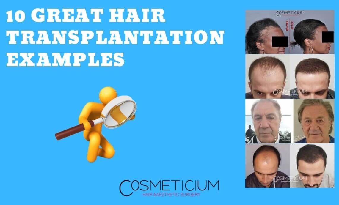 10 Great Hair Transplantation Examples with Before and After Photos