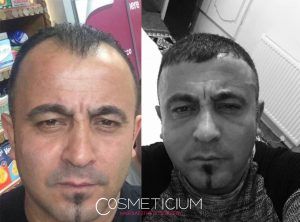 hair transplant before and after at cosmeticium